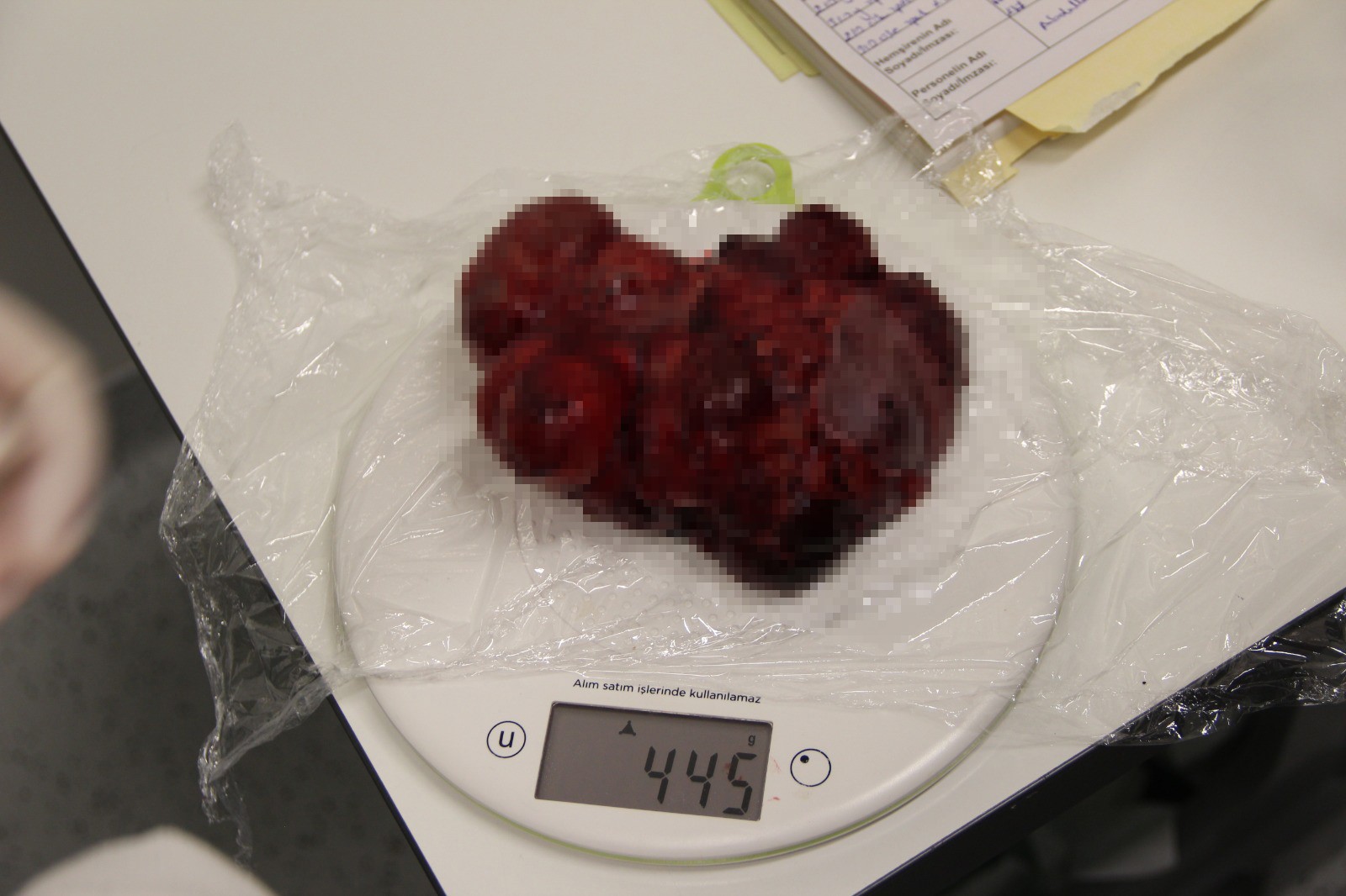 Boynunda Dev Tümörle Doğan Bebek Hayata Tutundu (7)