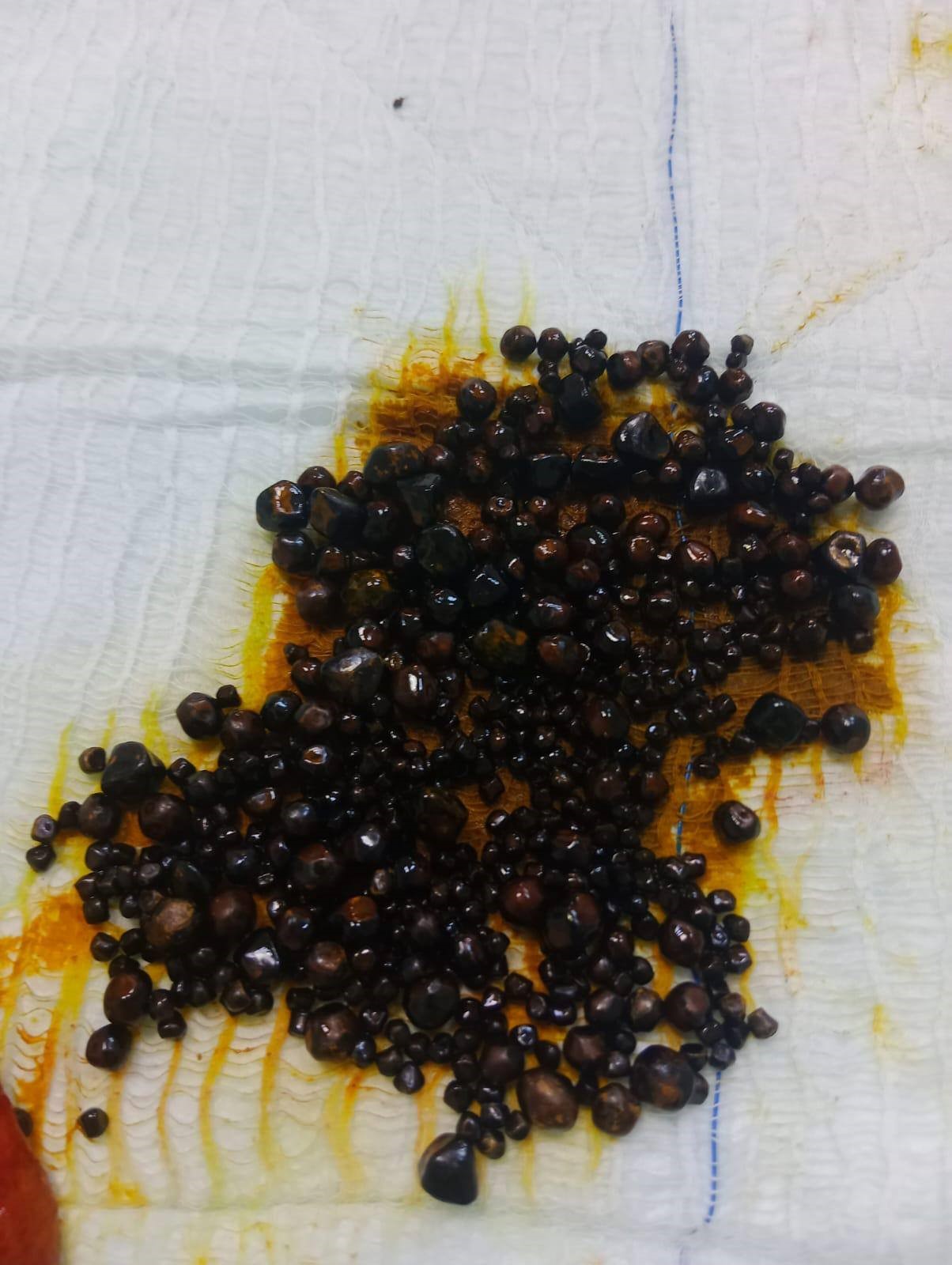 Doktorlar Bile Gözlerine Inanamadı, Safra Kesesinden 491 Taş Çıkartıldı (2)