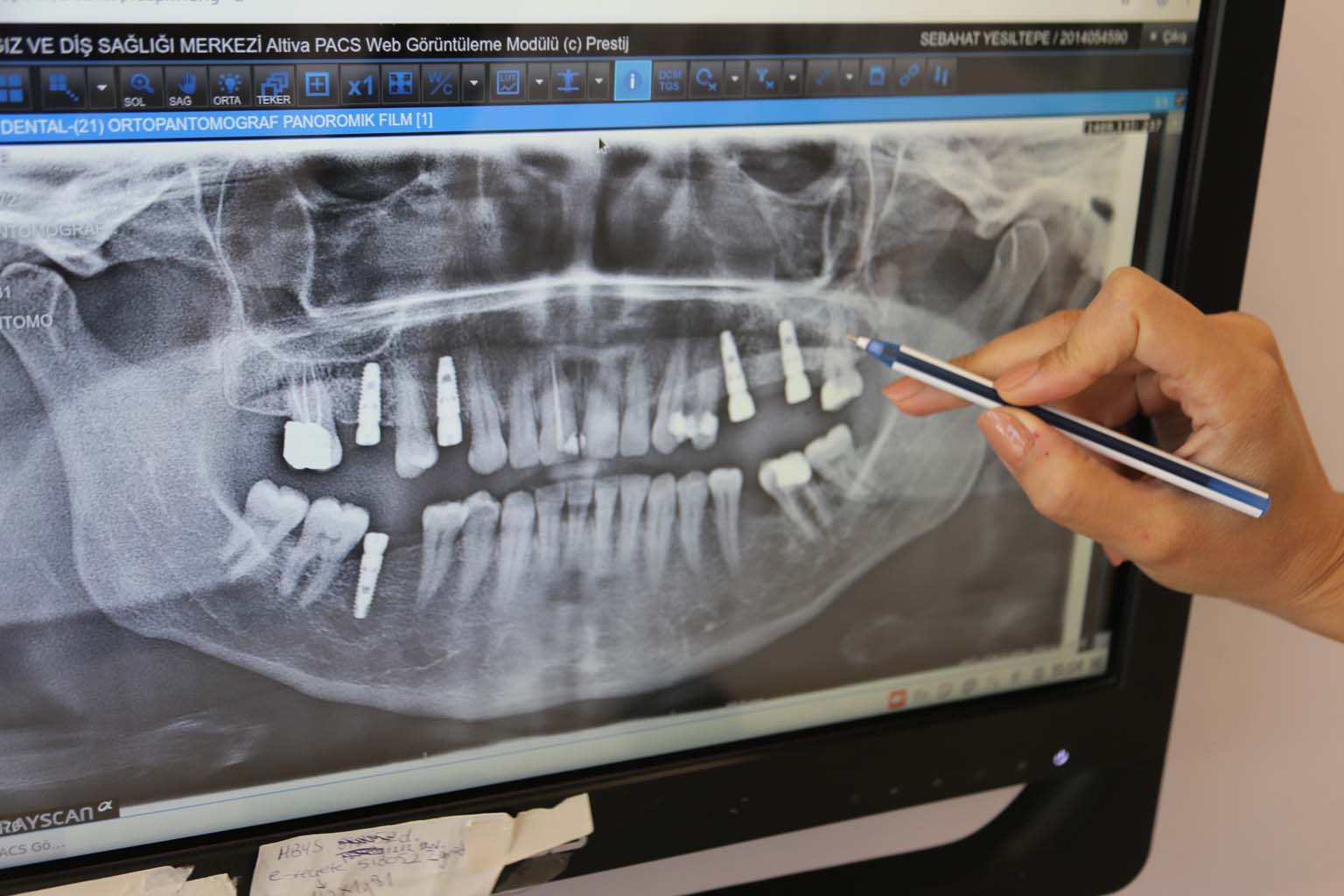 Aydın, İzmir, Denizli, Muğla Implant Tedavisi Için Buraya Gidiyor. (3)