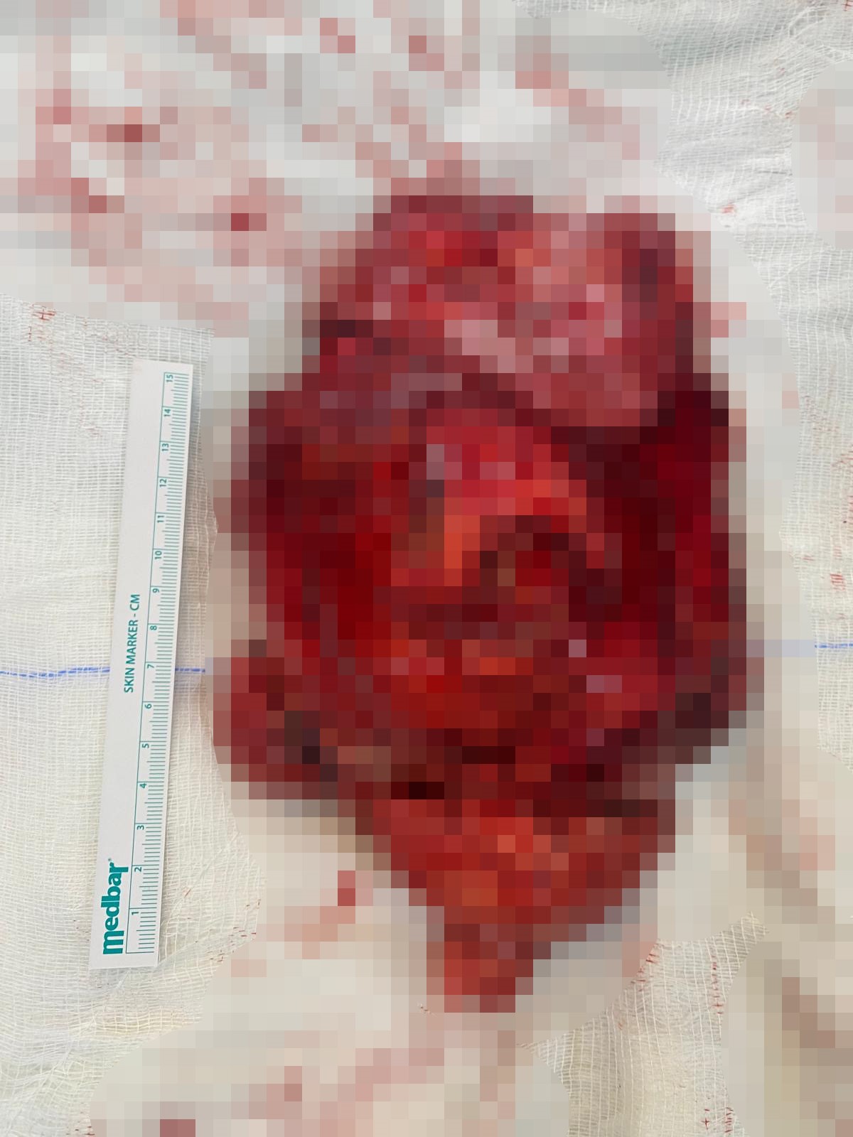 Tıpta Ender Rastlanan Dev Tümör Ameliyatla Çıkarıldı (3)