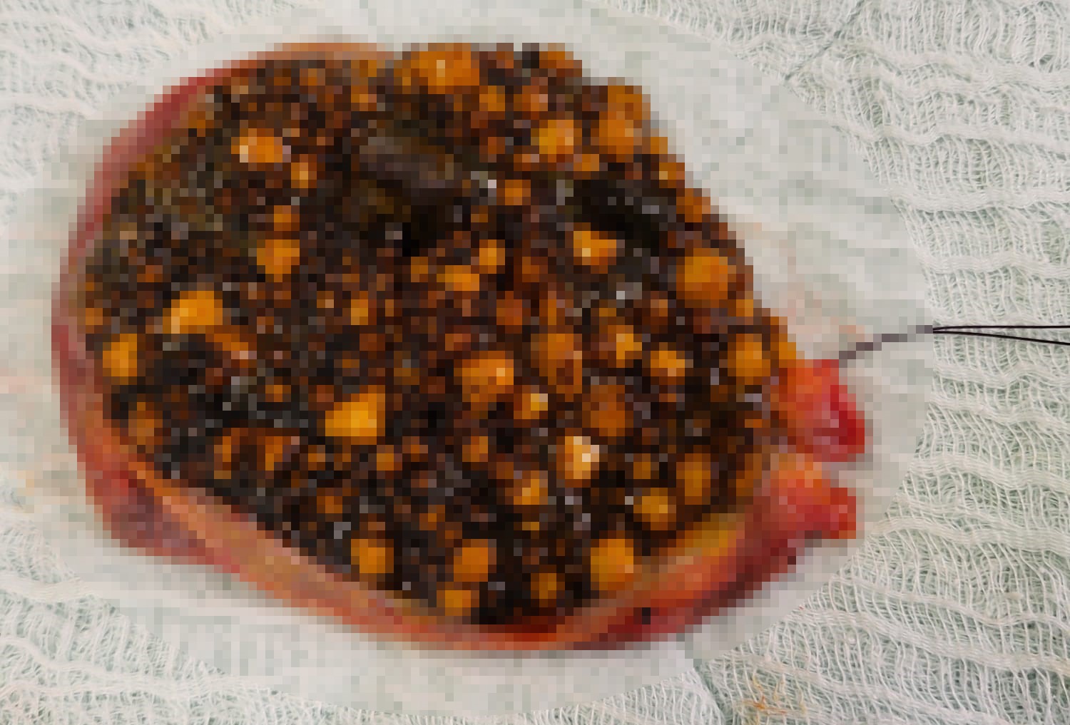 Karın Ağrısıyla Gitti, Karnından Çıkanlar Doktorları Da Şaşırttı (3)