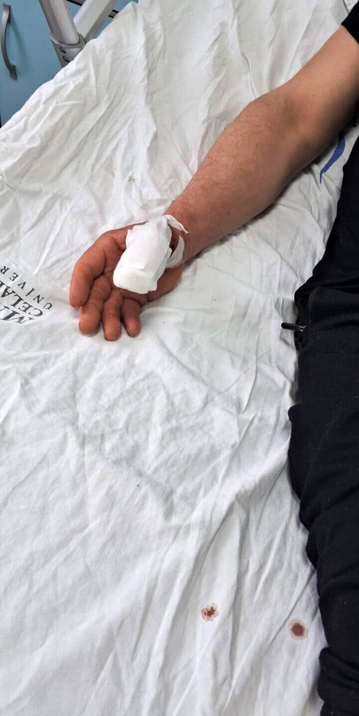 Başıboş Köpeklerin Saldırısına Uğrayan Adamın Baş Parmağı Koptu (3)