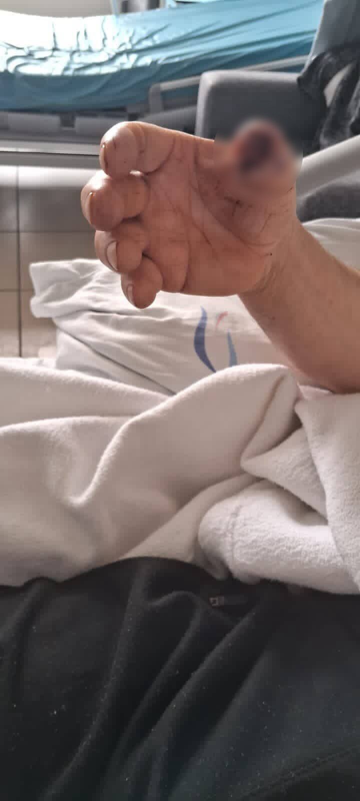 Başıboş Köpeklerin Saldırısına Uğrayan Adamın Baş Parmağı Koptu (4)